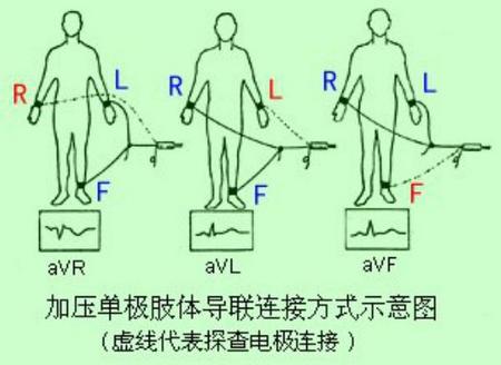 三导联示意图.jpg